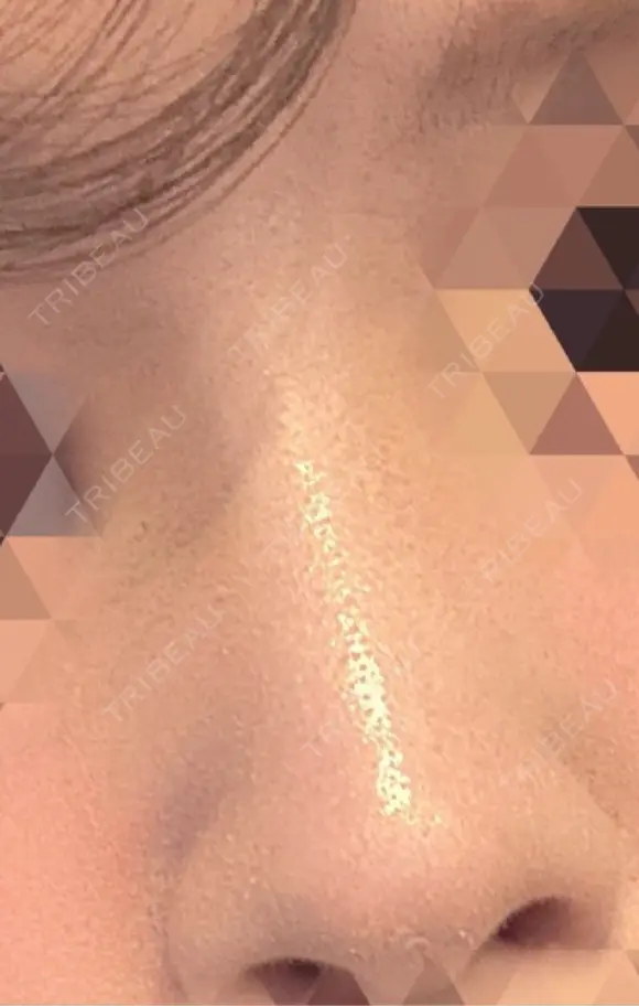 隆鼻術 形成外科と美容外科のクリニック池袋 AFTER メイン用