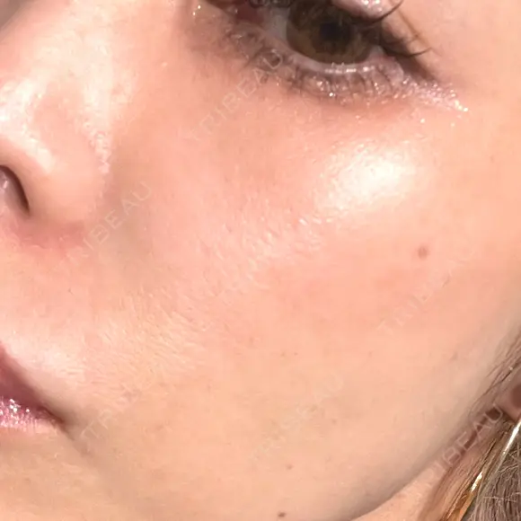 ピコレーザートーニング（美白・肝斑） / ピコフラクショナルレーザー（毛穴・ニキビ跡） しんゆり美容健康クリニック DAY 2 メイン用