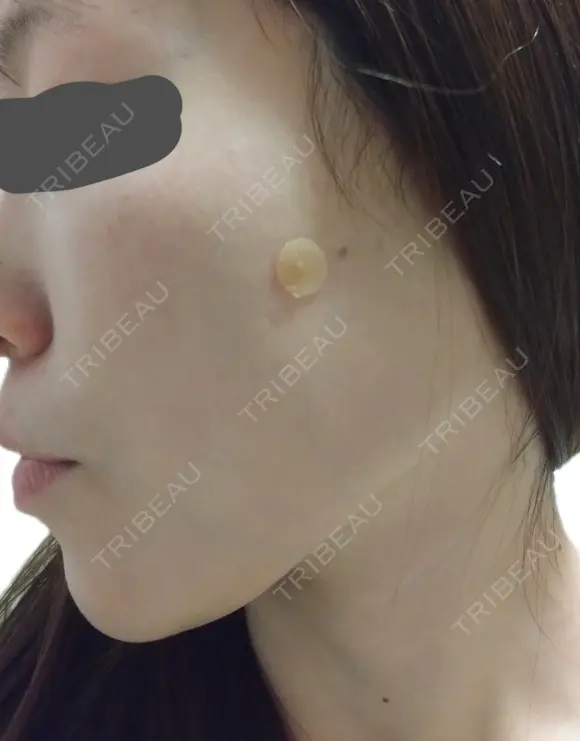 ほくろ・いぼ除去レーザー（肌） Fellez Clinic【フェルズクリニック】 DAY 0 メイン用