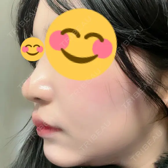 ヒアルロン酸注入（鼻） / ボトックス（人中） A CLINIC（エークリニック） 福岡院 DAY 9 メイン用