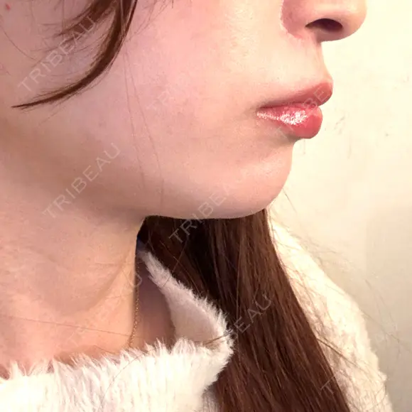 インディバ（顔） 渋谷美容外科クリニック 新橋院 DAY 4 メイン用