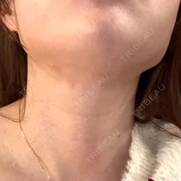 インディバ（顔） 渋谷美容外科クリニック 新橋院 DAY 6 メイン用