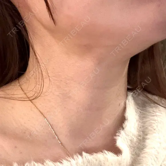 インディバ（顔） 渋谷美容外科クリニック 新橋院 DAY 7 メイン用