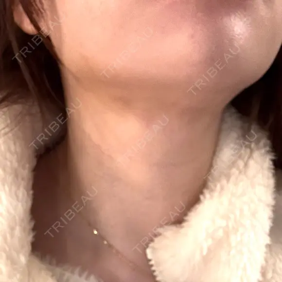 インディバ（顔） 渋谷美容外科クリニック 新橋院 DAY 8 メイン用