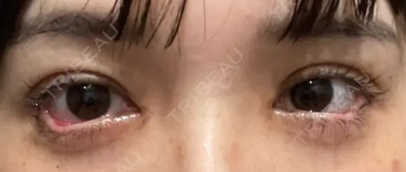 目尻切開 / タレ目形成・グラマラスライン（埋没） LOUIS CLINIC 二子玉川院【ルイクリニック】 DAY 2 メイン用