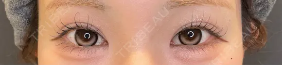 目尻切開 / タレ目形成・グラマラスライン（埋没） LOUIS CLINIC 二子玉川院【ルイクリニック】 AFTER メイン用