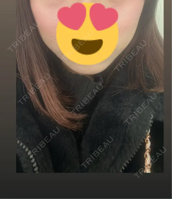 インモード 東京素肌クリニック 銀座本院 AFTER メイン用