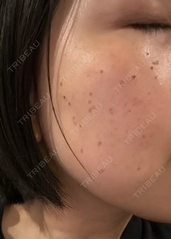 シミ取りレーザー / ピコレーザートーニング（美白・肝斑） 東京シルククリニック 東京神田院 DAY 7 メイン用