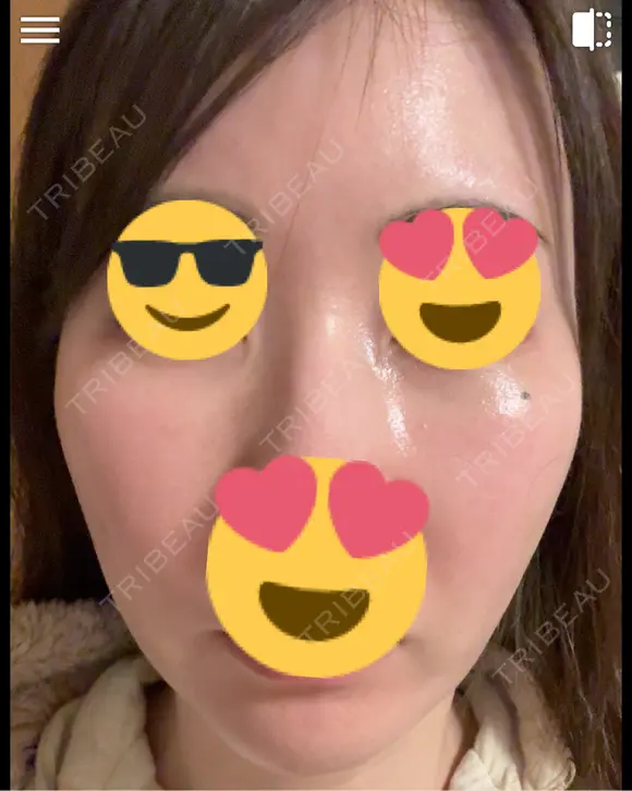 毛穴洗浄（ハイドラフェイシャルなど） / ピコレーザートーニング（美白・肝斑） 表参道ウィズ・クリニック DAY 5 メイン用