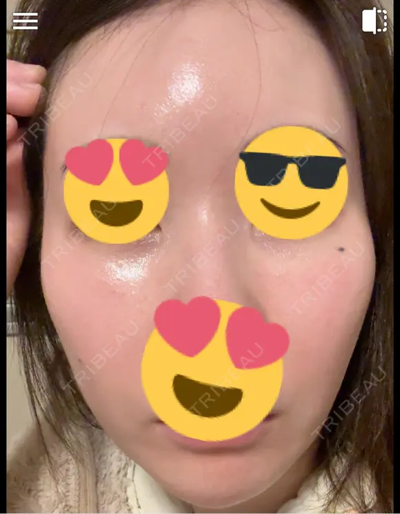 毛穴洗浄（ハイドラフェイシャルなど） / ピコレーザートーニング（美白・肝斑） 表参道ウィズ・クリニック DAY 8 メイン用