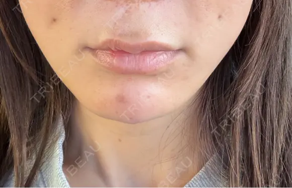 ヒアルロン酸注入（あご） 千葉美容外科アイビークリニック DAY 0 メイン用