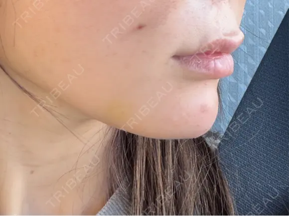 ヒアルロン酸注入（あご） 千葉美容外科アイビークリニック DAY 0 メイン用