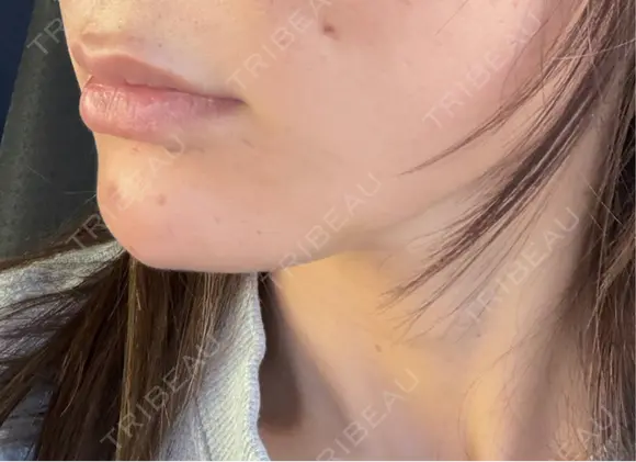 ヒアルロン酸注入（あご） 千葉美容外科アイビークリニック DAY 0 メイン用