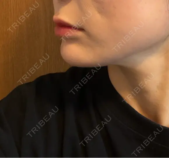 ヒアルロン酸注入（あご） 千葉美容外科アイビークリニック DAY 10 メイン用