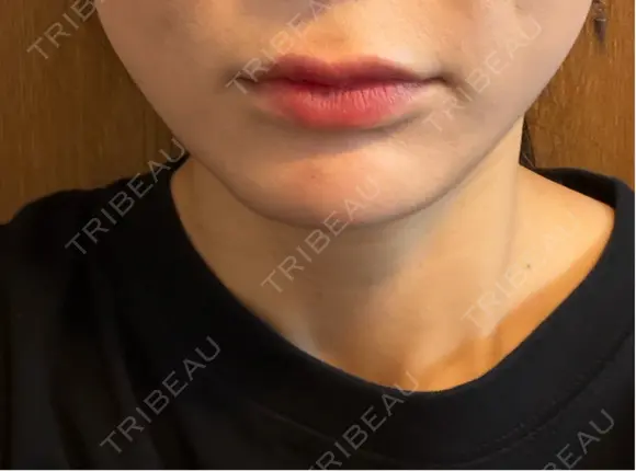 ヒアルロン酸注入（あご） 千葉美容外科アイビークリニック DAY 10 メイン用