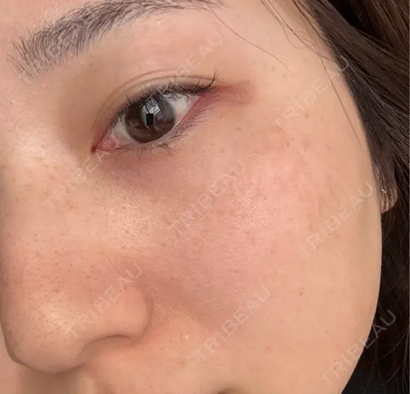 ピーリング（ハリ・ツヤ） / ルメッカ L‘amour clinic Tokyo【ラムールクリニック東京】 AFTER メイン用