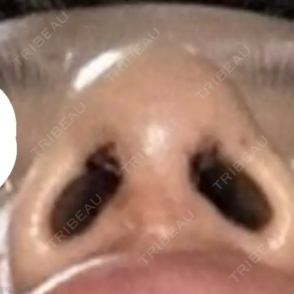 鼻尖形成（切開） リッツ美容外科 大阪院 DAY 4 メイン用
