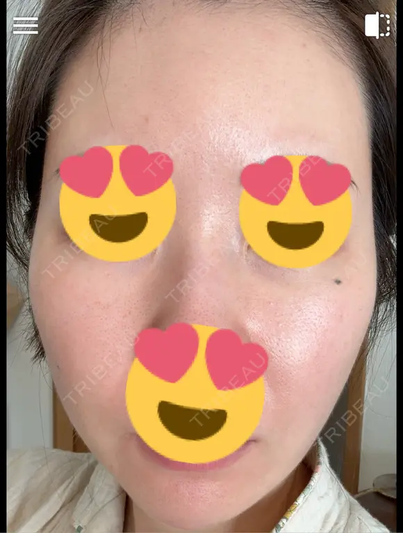 毛穴洗浄（ハイドラフェイシャルなど） / ピコレーザートーニング（美白・肝斑） 表参道ウィズ・クリニック DAY 9 メイン用