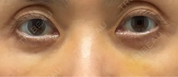 スネコス 札幌美容外科ネビュラクリニック DAY 11 メイン用