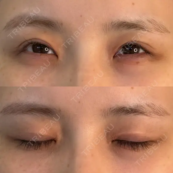 二重切開 / 眼瞼下垂（切開） / スレッドノーズ / ヒアルロン酸注入（鼻翼基部） オーキッド美容クリニック東京御徒町 DAY 492 メイン用