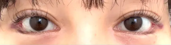 目尻切開 / タレ目形成・グラマラスライン（埋没） LOUIS CLINIC 二子玉川院【ルイクリニック】 DAY 1 メイン用