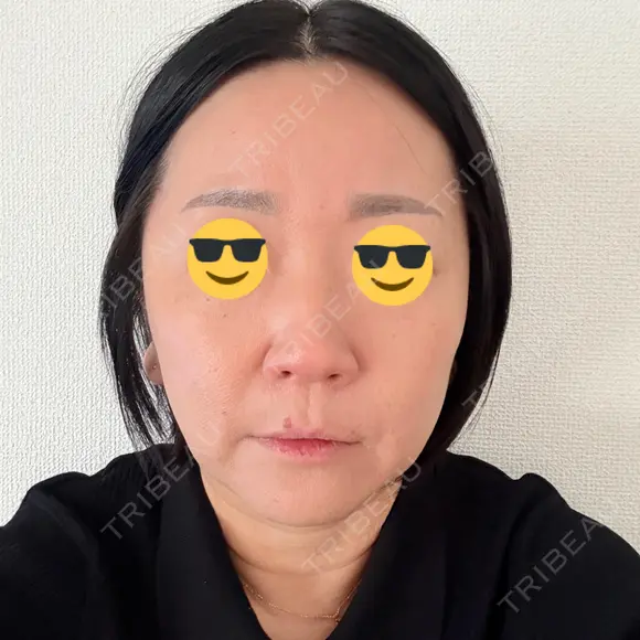 脂肪溶解注射（顔） ルラ美容クリニック 仙台院 / ルラスキンクリニック 仙台院 DAY 3 メイン用