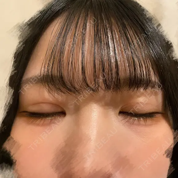 二重埋没 東京シンデレラ美容外科 池袋院 DAY 19 メイン用