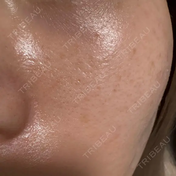 ルメッカ 博多美容外科/美容皮膚科 ビラビューティークリニック DAY 31 メイン用