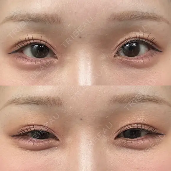 ヒアルロン酸注入（涙袋） 小倉美容外科/美容皮膚科 ビラビューティークリニック DAY 3 メイン用