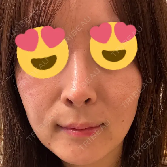 ボトックス（エラ・小顔） / ボトックス（口角） DMTC美容皮膚科 大宮院 DAY 4 メイン用