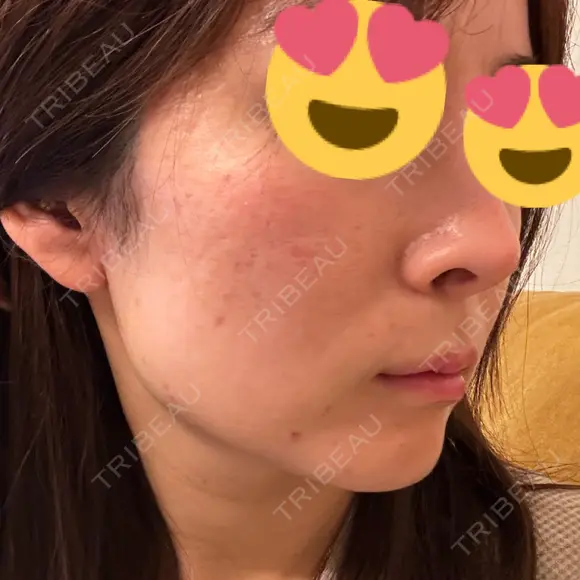 ボトックス（エラ・小顔） / ボトックス（口角） DMTC美容皮膚科 大宮院 DAY 4 メイン用