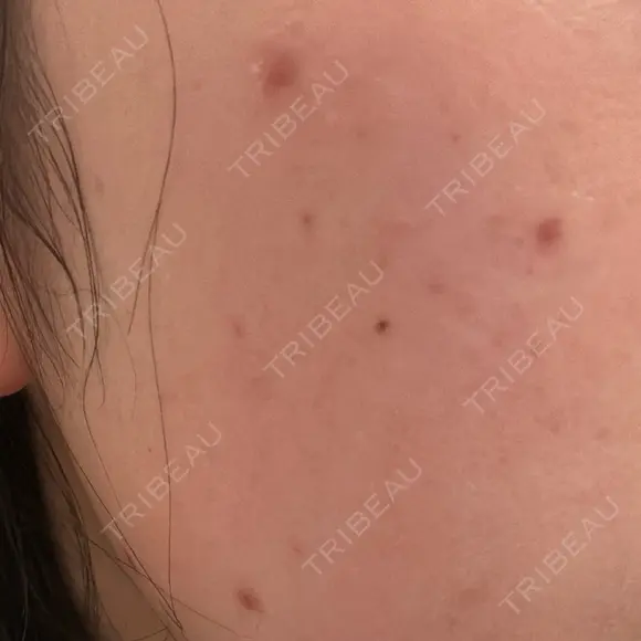 ほくろ・いぼ除去レーザー（肌） 心斎橋KT美容クリニック DAY 4 メイン用