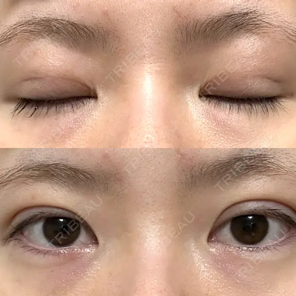 二重埋没 / 上まぶたの脂肪取り アリエル美容クリニック 郡山院 DAY 35 メイン用