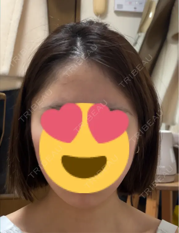 脂肪吸引（顔） / 下まぶたの脂肪取り 東京脂肪吸引クリニック AFTER メイン用