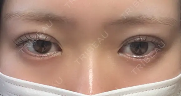 二重埋没 EMMA CLINIC（エマクリニック） DAY 1 メイン用