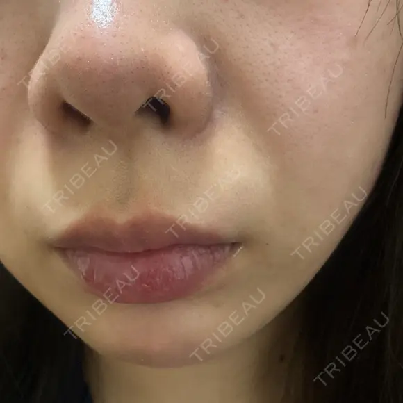 マイクロボトックス Natural Skin Clinic 自由ヶ丘院 AFTER メイン用
