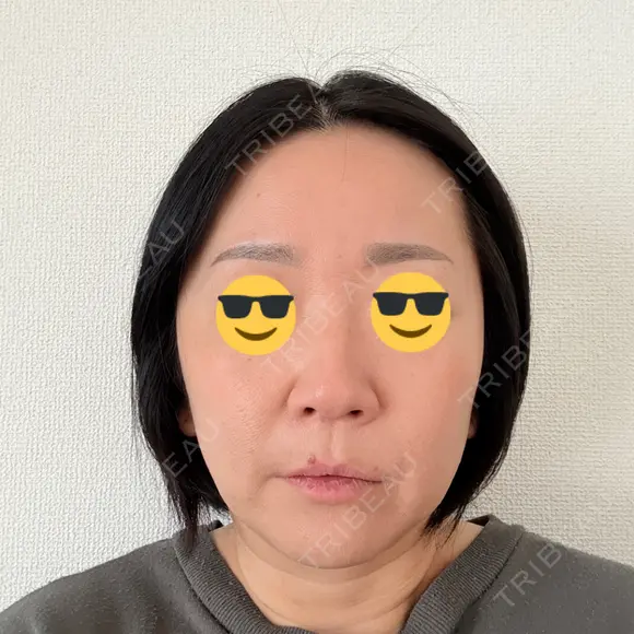 脂肪溶解注射（顔） ルラ美容クリニック 仙台院 / ルラスキンクリニック 仙台院 DAY 4 メイン用