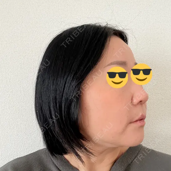 脂肪溶解注射（顔） ルラ美容クリニック 仙台院 / ルラスキンクリニック 仙台院 DAY 4 メイン用