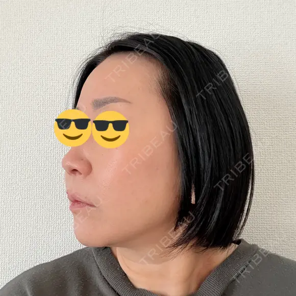 脂肪溶解注射（顔） ルラ美容クリニック 仙台院 / ルラスキンクリニック 仙台院 DAY 4 メイン用