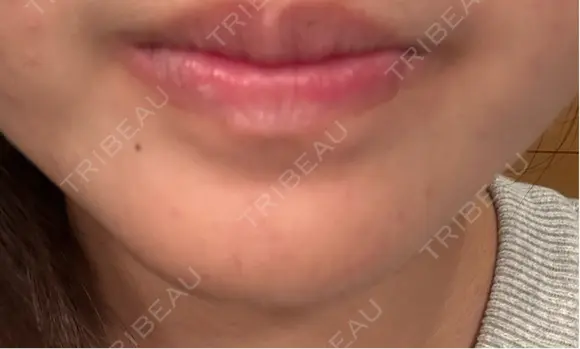 ボトックス（あご） / ボトックス（エラ・小顔） / ボトックス（口角） STELLA LUNNA CLINIC DAY 4 メイン用