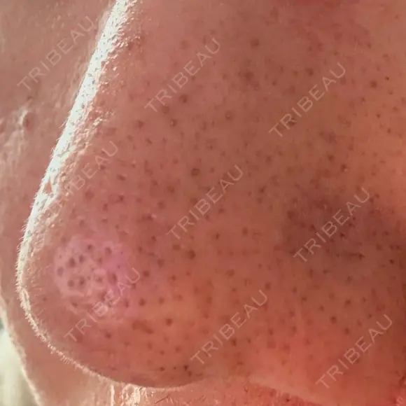 アグネス 日本美容・医療クリニック 六本木院 AFTER メイン用