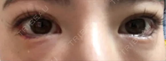 目尻切開 / タレ目形成・グラマラスライン（埋没） LOUIS CLINIC 二子玉川院【ルイクリニック】 DAY 3 メイン用