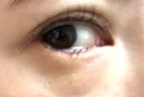 目尻切開 / タレ目形成・グラマラスライン（埋没） LOUIS CLINIC 二子玉川院【ルイクリニック】 DAY 3 メイン用