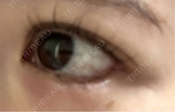 目尻切開 / タレ目形成・グラマラスライン（埋没） LOUIS CLINIC 二子玉川院【ルイクリニック】 DAY 3 メイン用