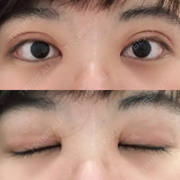 二重切開 / 目頭切開 / ほくろ・いぼ切除（肌） / 上まぶたたるみ取り / 上まぶたの脂肪取り 東京美容外科 銀座院 DAY 53 メイン用