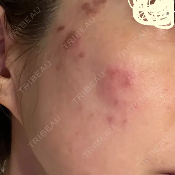 プラセンタ注射 / シミ取りレーザー S-Laboクリニック 渋谷院 DAY 1 メイン用