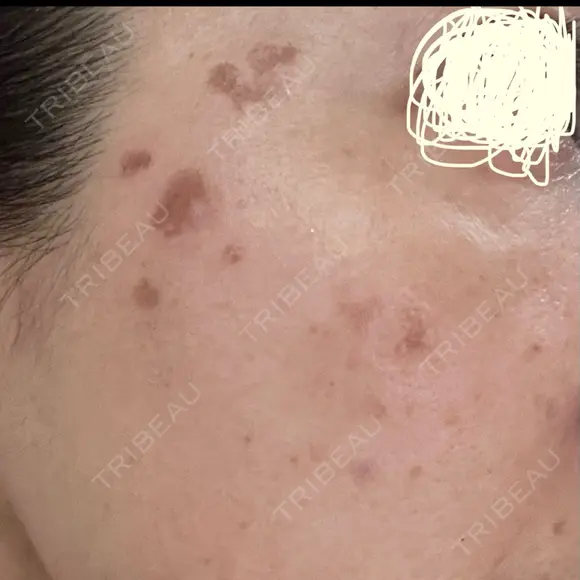 プラセンタ注射 / シミ取りレーザー S-Laboクリニック 渋谷院 DAY 2 メイン用