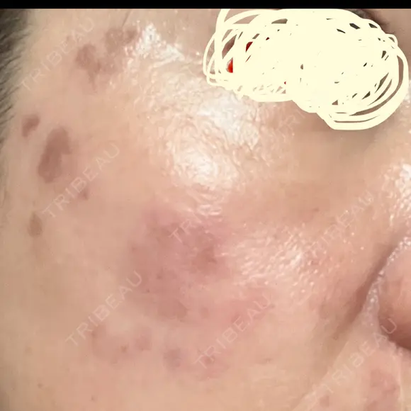 プラセンタ注射 / シミ取りレーザー S-Laboクリニック 渋谷院 DAY 0 メイン用