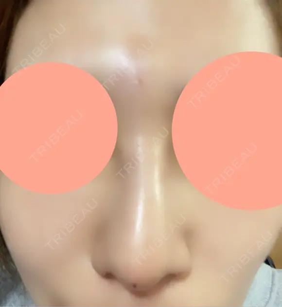ヒアルロン酸注入（鼻） 博多美容外科/美容皮膚科 ビラビューティークリニック DAY 0 メイン用