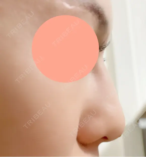 ヒアルロン酸注入（鼻） 博多美容外科/美容皮膚科 ビラビューティークリニック DAY 0 メイン用